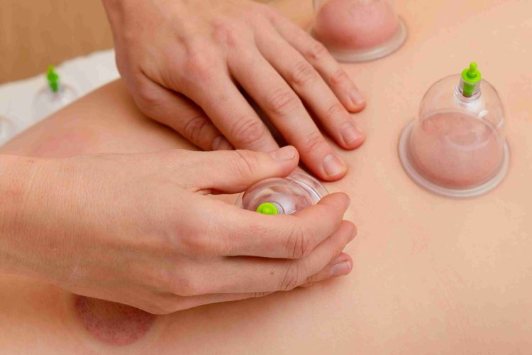 Masaje de cupping